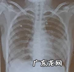 妇科支原体感染怎么治疗 支气管炎支原体感染怎么治疗