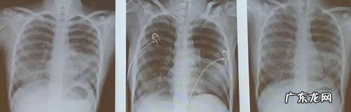 妇科支原体感染怎么治疗 支气管炎支原体感染怎么治疗