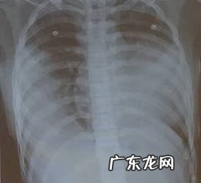 妇科支原体感染怎么治疗 支气管炎支原体感染怎么治疗