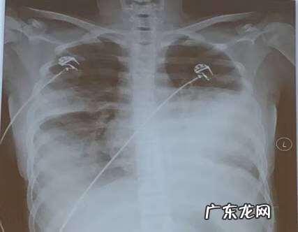 妇科支原体感染怎么治疗 支气管炎支原体感染怎么治疗