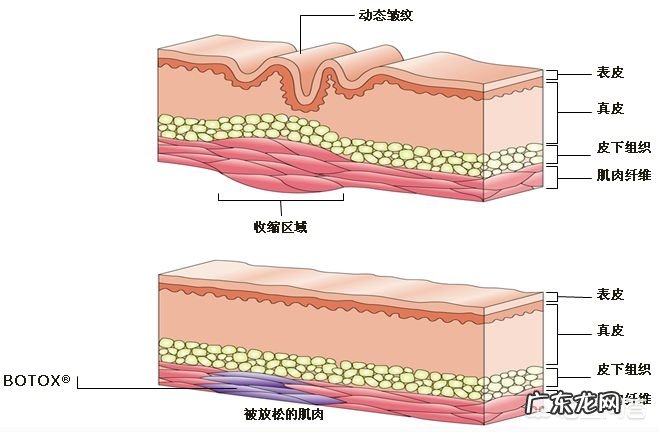 20岁就有抬头纹了,要怎么去除?