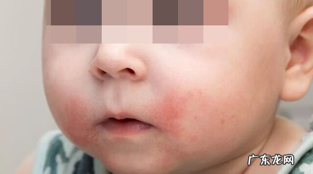 为什么孩子老是反复过敏 小儿过敏了怎么办最快方法