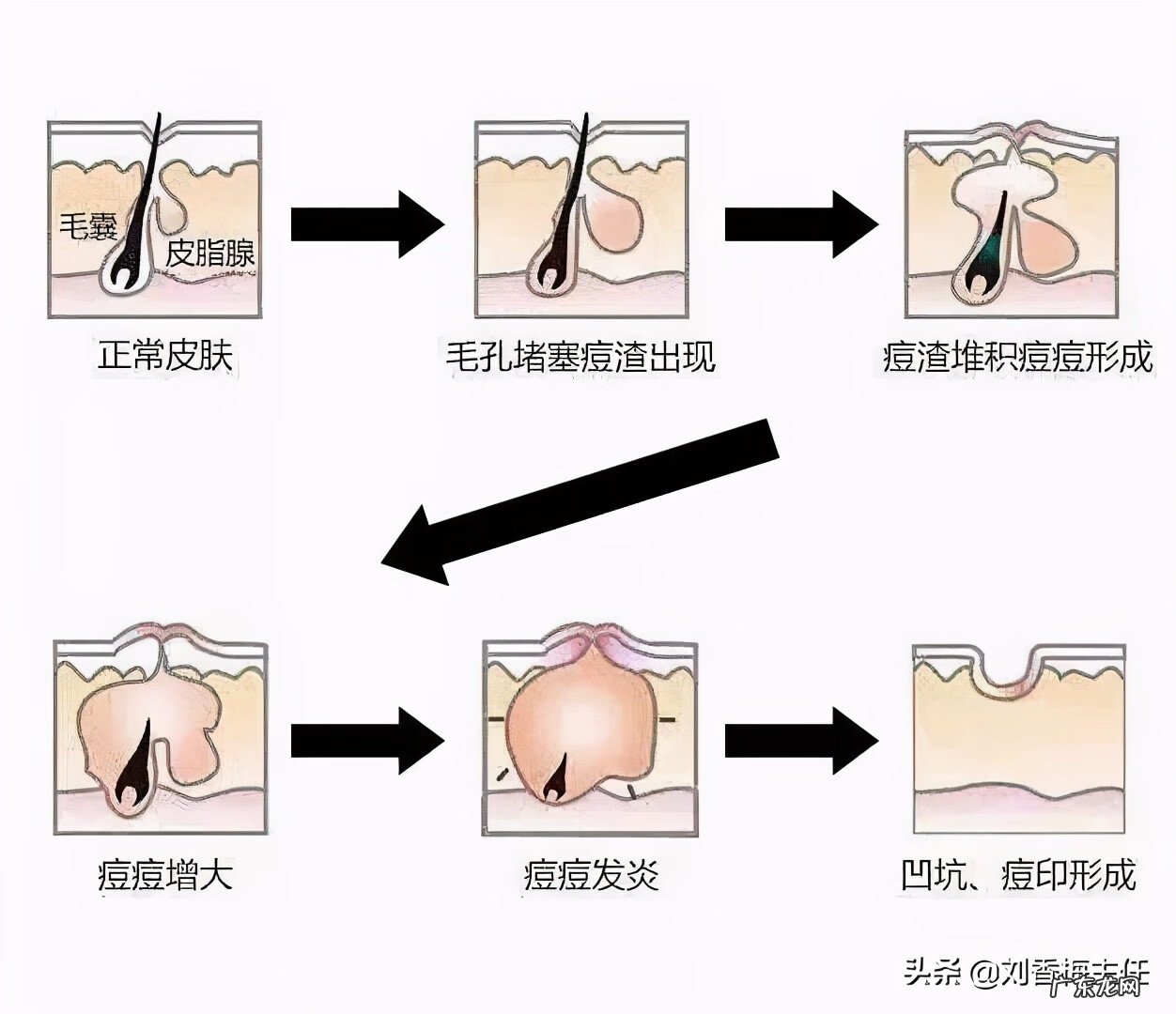治疗痘坑最有效的方法是什么 有痘坑怎么办啊