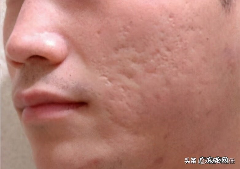 治疗痘坑最有效的方法是什么 有痘坑怎么办啊