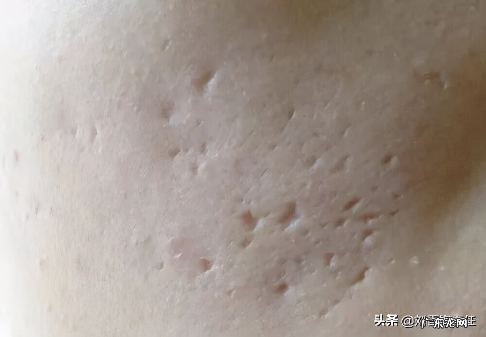 治疗痘坑最有效的方法是什么 有痘坑怎么办啊