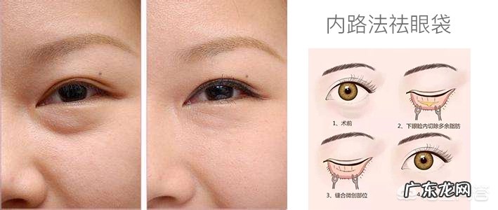 去除眼袋有哪些好办法呢?