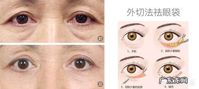 去除眼袋有哪些好办法呢?
