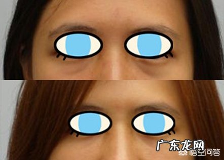 去除眼袋有哪些好办法呢?