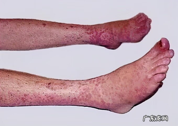 过敏性紫癜肾炎症状表现 过敏性紫癜肾炎