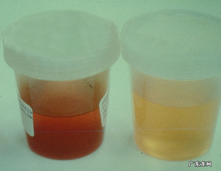 过敏性紫癜肾炎症状表现 过敏性紫癜肾炎