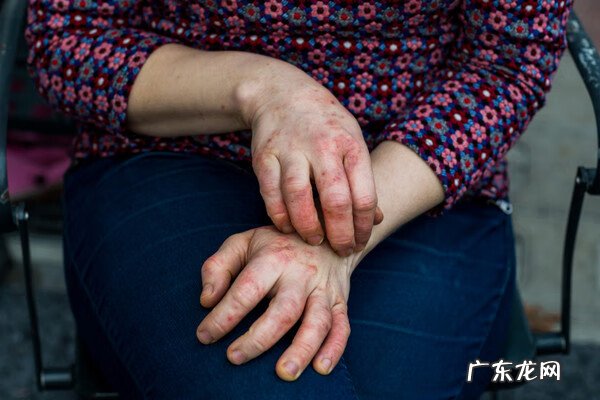 汗疱疹是什么原因引起图片