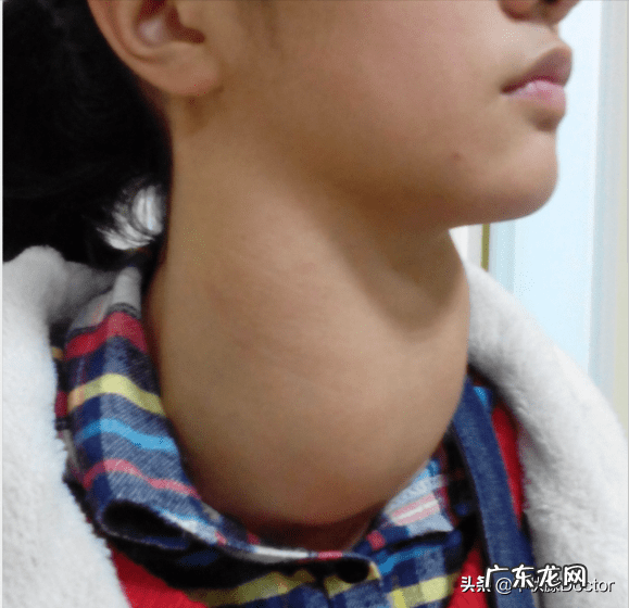 甲状腺结节挂什么科最好 甲状腺结节看什么科比较好