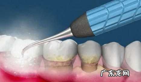 医院洗牙贵不贵 整容医院洗牙安全吗