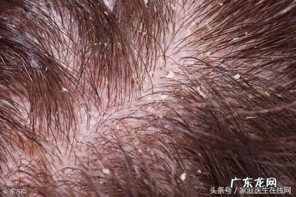 头皮屑太多怎么弄 头皮屑多怎么办呢
