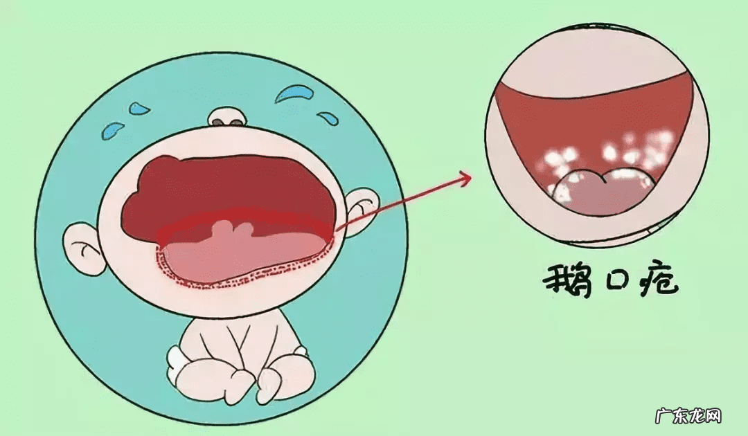 鹅口疮老是反复怎么办 鹅口疮反复发作