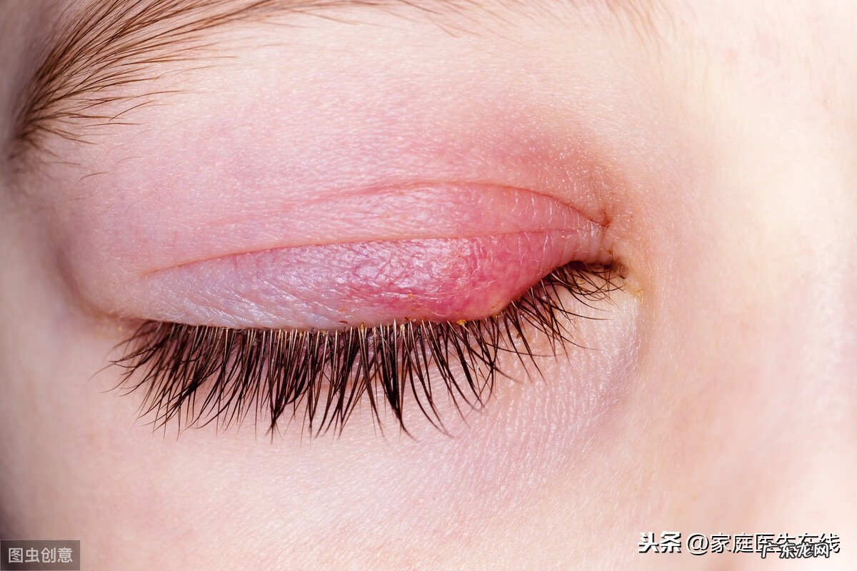 麦粒肿是什么原因形成的 麦粒肿原因是什么