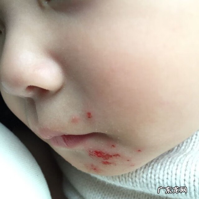 肚皮上长瘊子有什么说法 瘊子长在肚子上代表什么