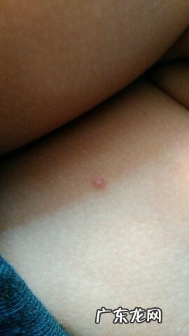 肚皮上长瘊子有什么说法 瘊子长在肚子上代表什么