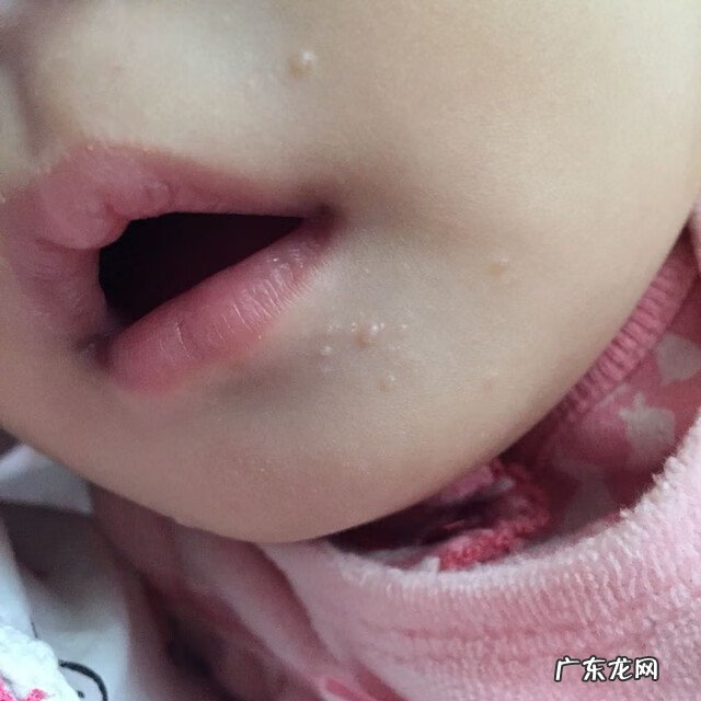 肚皮上长瘊子有什么说法 瘊子长在肚子上代表什么