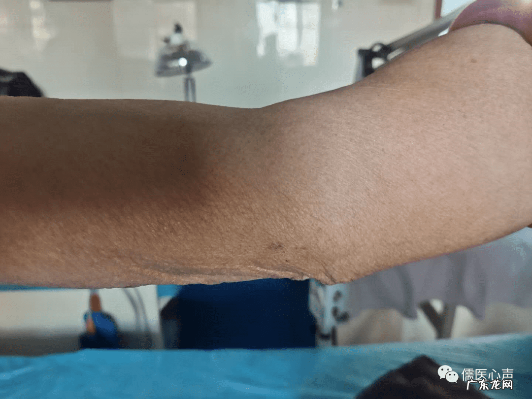 虎口按压酸痛是肾虚吗 虎口肉变薄代表什么