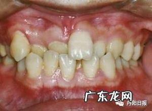 牙列拥挤的矫治方法论述题 牙列拥挤有什么危害图片