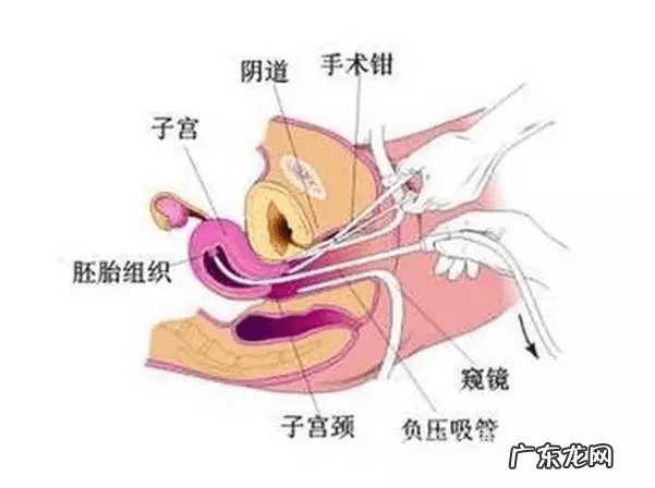 刮宫需要住院吗 刮宫和人流的区别在哪