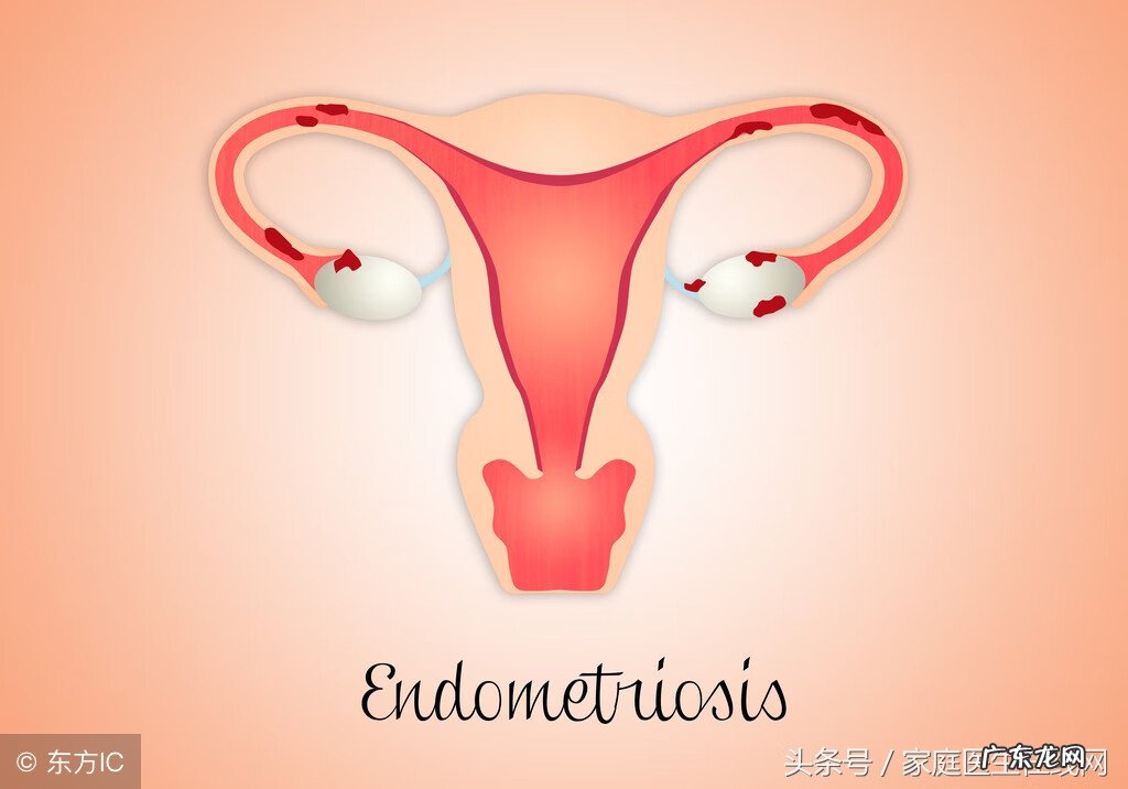 子宫脱垂的原因有哪些 子宫脱垂怎么办