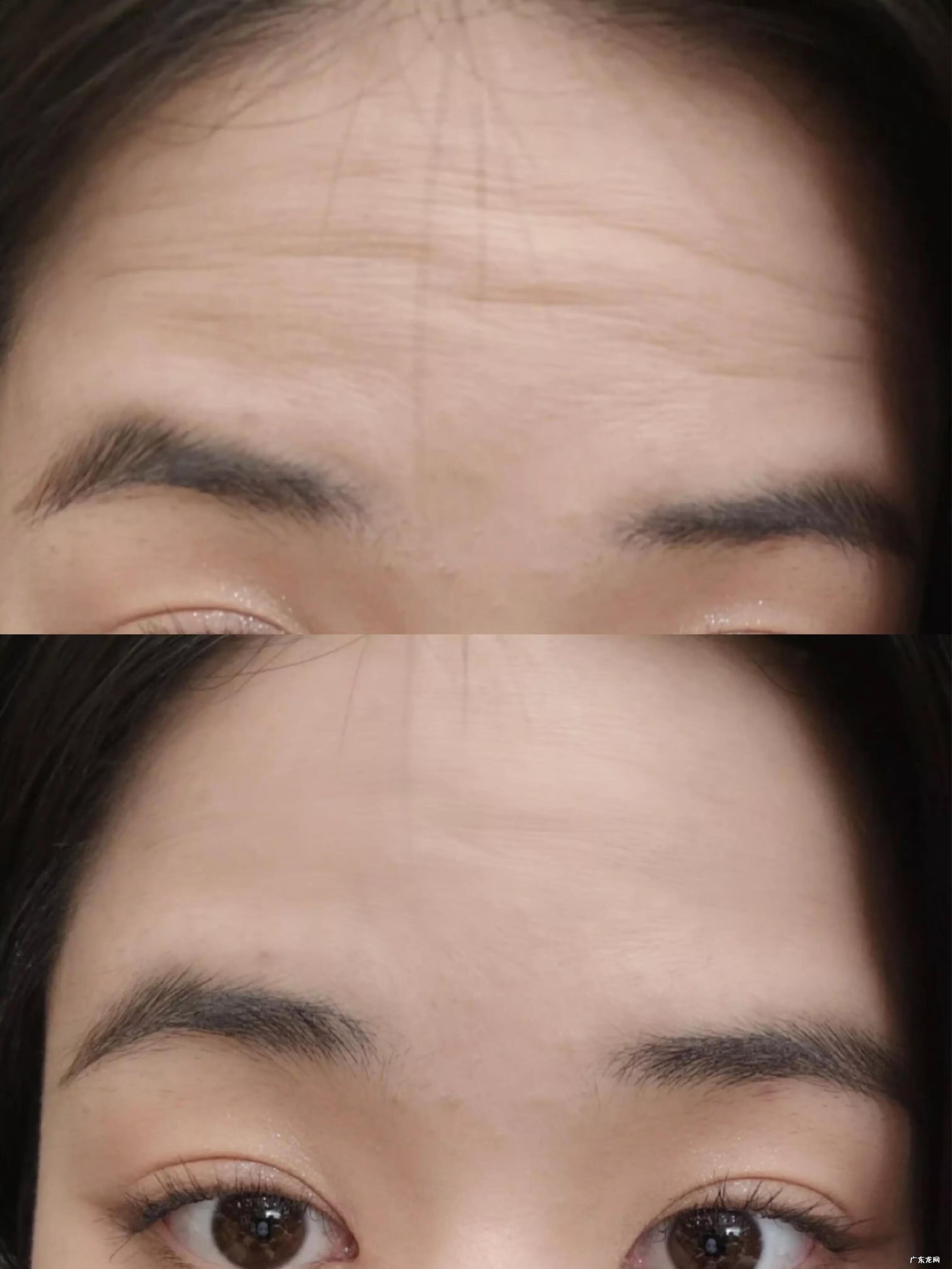 一抬头就有抬头纹怎么办 年轻就有抬头纹怎么办