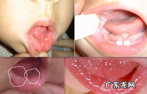 鹅口疮是什么原因造成的 什么是鹅口疮图片