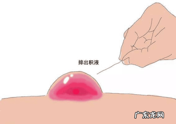 脚心长小水泡是怎么回事 脚心长水泡了怎么办