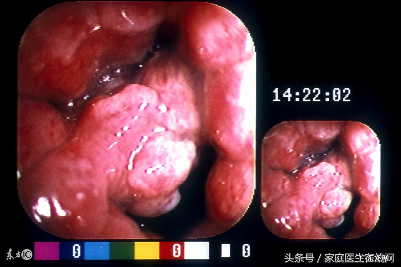 胃癌有哪些症状前兆 胃癌的早期症状有哪些