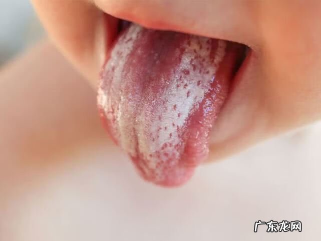 鹅口疮的症状 鹅口疮图片