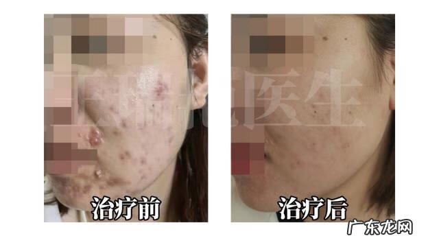 女生去痘痘的方法 女生祛痘最有效的方法