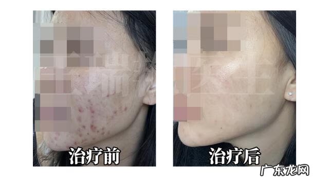 女生去痘痘的方法 女生祛痘最有效的方法