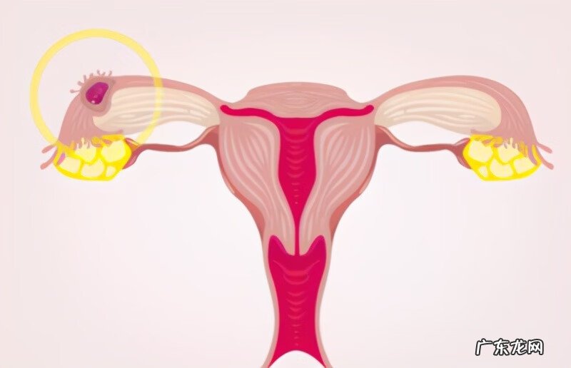 什么是宫外孕症状早期 刚怀孕宫外孕有什么症状