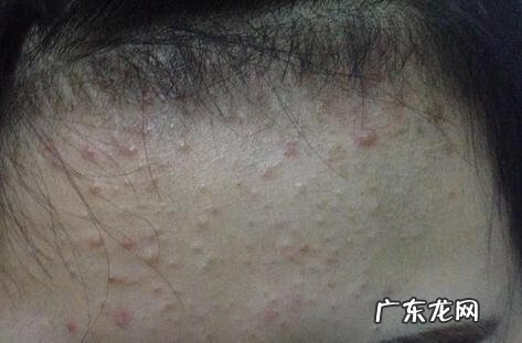 防治痤疮技巧 痤疮预防措施