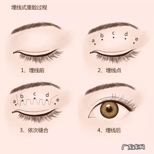 埋线双眼皮手术有危险吗 埋线双眼皮注意事项?