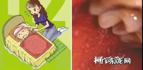 人体100种皮肤病对照图 麻疹