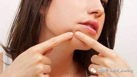 嘴巴周围总是长痘痘是什么原因 嘴巴周围长痘痘是什么原因引起的