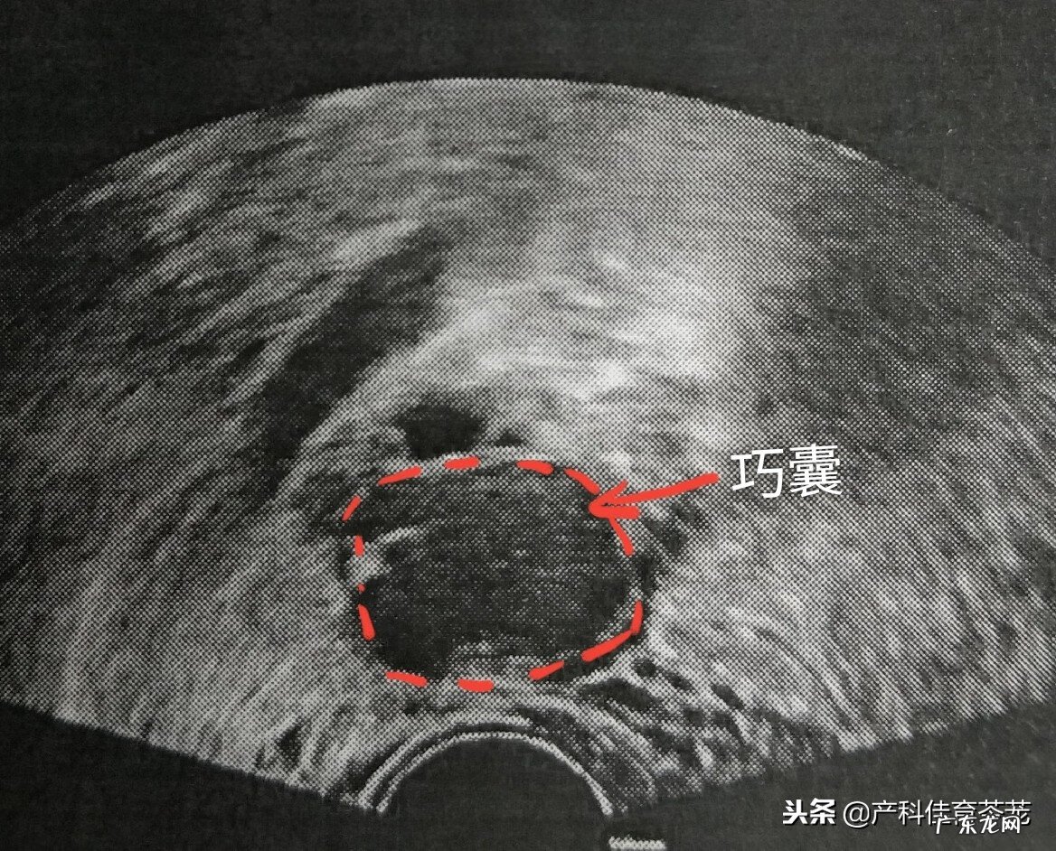 生理性卵巢囊肿是怎么引起的 生理性卵巢囊肿怎么形成的