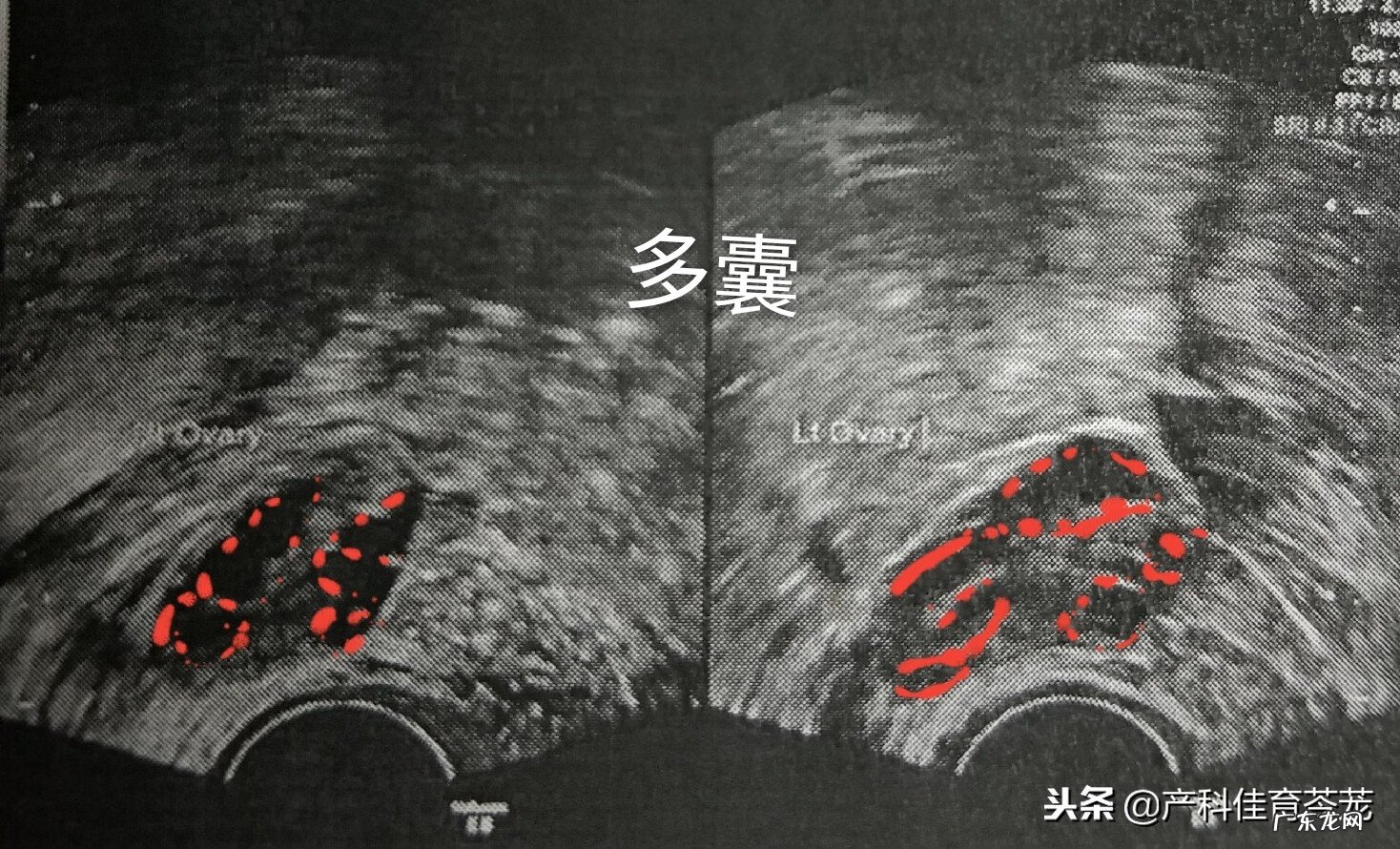 生理性卵巢囊肿是怎么引起的 生理性卵巢囊肿怎么形成的