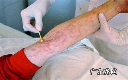 整天怀疑自己有艾滋病 艾滋潜伏期一般是多久