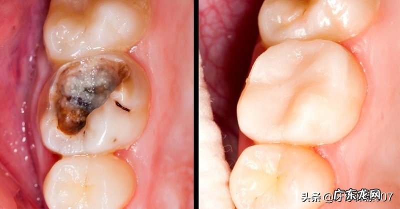 嘴巴里最里面的一颗牙齿被虫子吃了一半,也不痛,要不要去补?