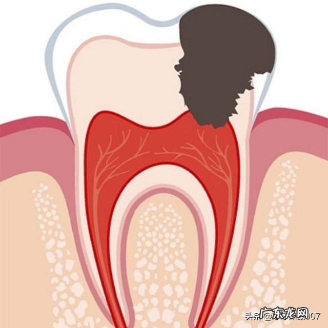 嘴巴里最里面的一颗牙齿被虫子吃了一半,也不痛,要不要去补?