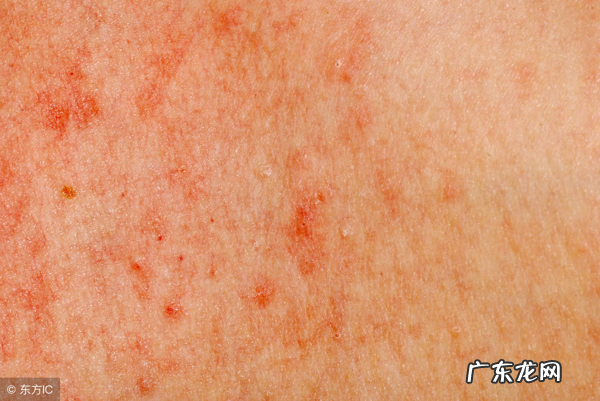 儿童病毒性疱疹图片 病毒性疱疹图片