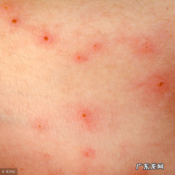 儿童病毒性疱疹图片 病毒性疱疹图片