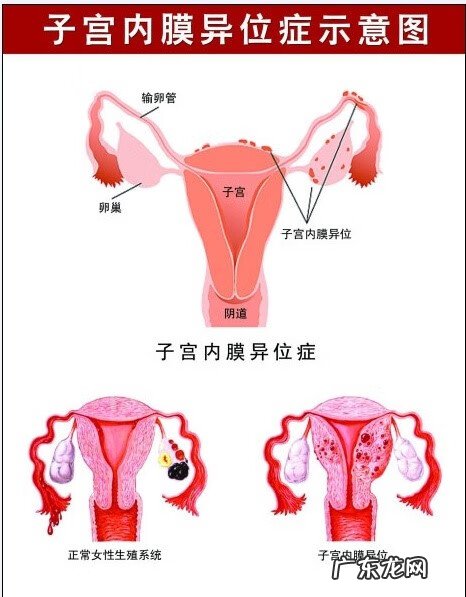 有子宫肌瘤要不要把环取出来 什么叫子宫内膜移位