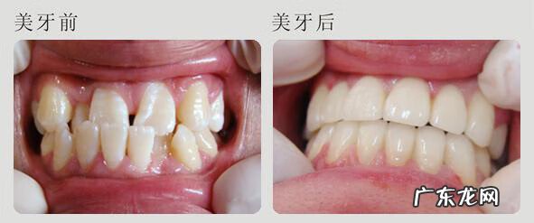 烤瓷牙套好吗 金属烤瓷牙好吗