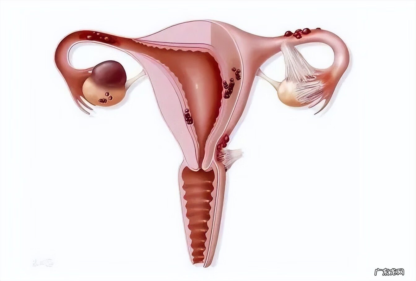 卵巢囊肿多大需要开腹手术 卵巢囊肿多大需做手术