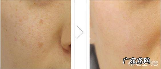 光子嫩肤好,还是水光针好?两者能同时做吗?